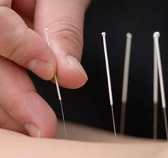 Cinci beneficii ale acupuncturii