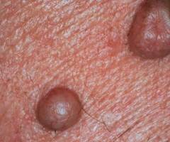 Tratamente cu rezultate promitatoare contra cancerului de piele