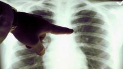 Romania, focar de tuberculoza - 4 bolnavi mor in fiecare zi