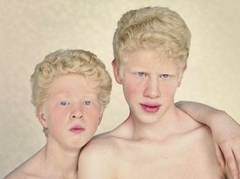 Albinismul - Ce spune medicul