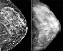 Cancerul ameninta femeile din cauza unei analize?
