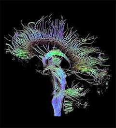 O noua metoda de scanare a creierului, pentru depistarea Alzheimer