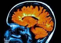 Scleroza multipla, cauzata de fluxul restrictionat de sange catre creier?
