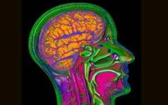 Vitamina B reface creierul celor care au suferit un atac cerebral