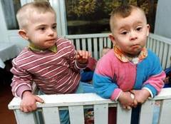 Din ce in ce mai multe cazuri de copii cu sindromul Down