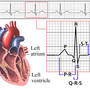 EKG-ul nu poate diagnostica toate anomaliile inimii