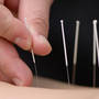 Cinci beneficii ale acupuncturii