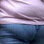 Obezitatea dubleaza riscul de pietre la rinichi