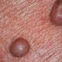 Tratamente cu rezultate promitatoare contra cancerului de piele