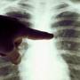 Romania, focar de tuberculoza - 4 bolnavi mor in fiecare zi