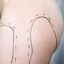 Celule stem, din grasimea rezultata in urma liposuctiei