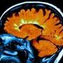 Scleroza multipla, cauzata de fluxul restrictionat de sange catre creier?