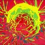 Un microcip descopera cancerul in 20 de minute
