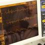 Primul stimulator cardiac wireless