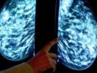 Noua metoda de a trata cancerul la san, prin inghetarea tumorilor
