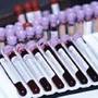 Test de sange care depisteaza cancerul de colon in faza incipienta